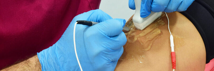 Image of procedure for percutaneous electrolysis